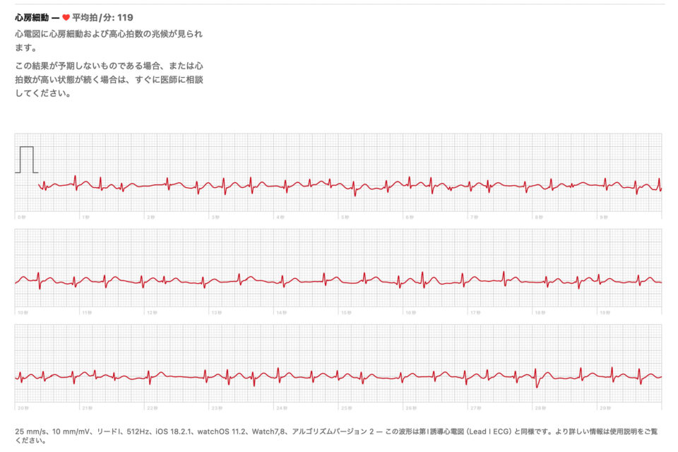 心房細動の可能性と判定されたApple Watchによる心電図例