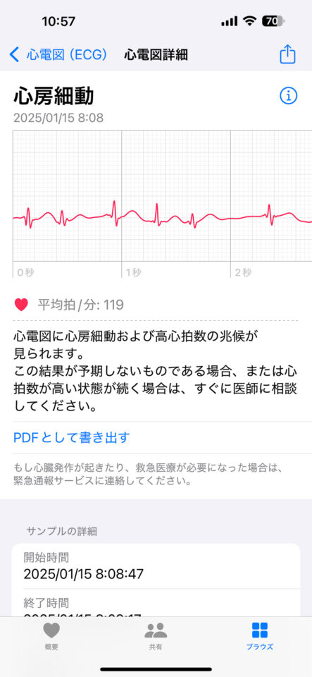 iOSヘルスケアアプリに表示された心房細動の心電図